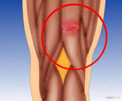 microfractura-muscular microfractura-muscular